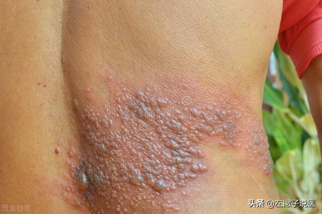 三,疱疹病毒复发时,最常见的三种皮肤性疾病要注意