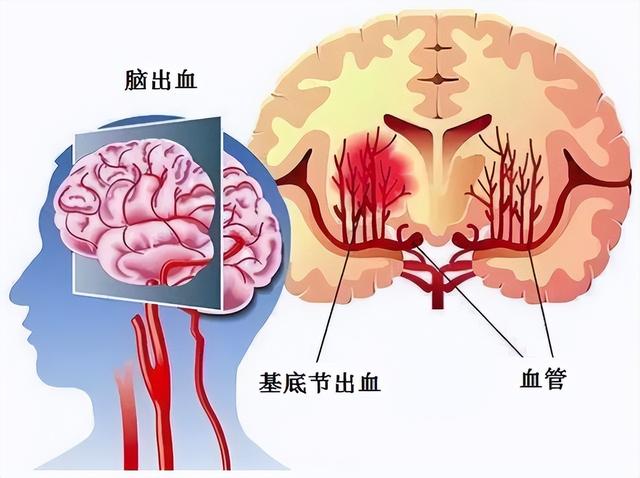 什么样的人容易得脑溢血，有哪些人容易患脑溢血（哪些人容易患上脑出血）