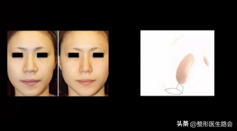 鼻翼肥大怎么办，鼻翼肥大怎么改善（如何改善鼻头圆和鼻翼宽）
