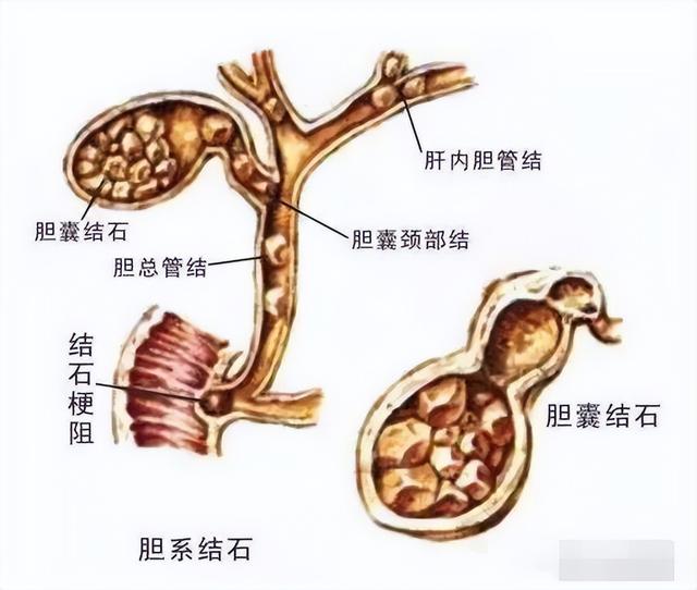 胆结石死亡率大吗，肝内胆管结石死亡率高吗（关于胆结石的那些事儿）