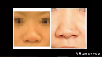 鼻翼肥大怎么办，鼻翼肥大怎么改善（如何改善鼻头圆和鼻翼宽）