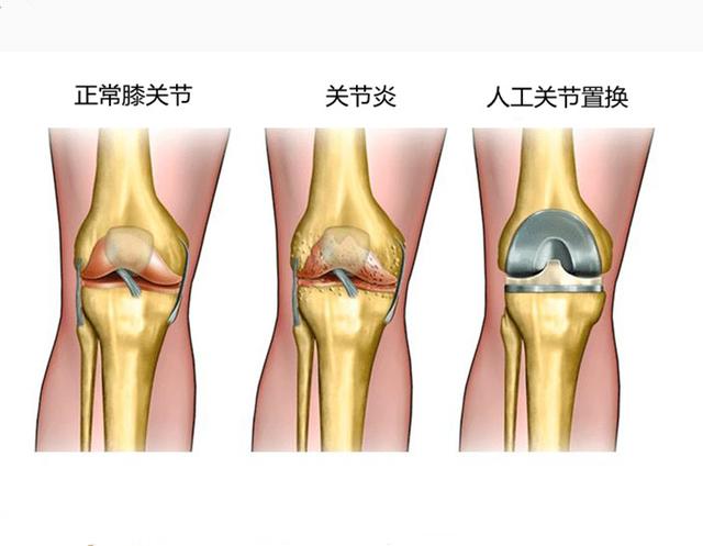 换膝关节太坑人了，换一个膝关节要多少钱（人工膝关节置换手术）