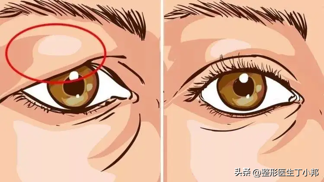 眼睛无神怎么改善，近视眼睛无神怎么改善（眼尾下垂、眼睛无神）