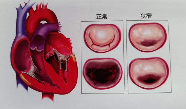 心脏癌最严重的肿瘤，得上心血管肉瘤，比癌症还可怕