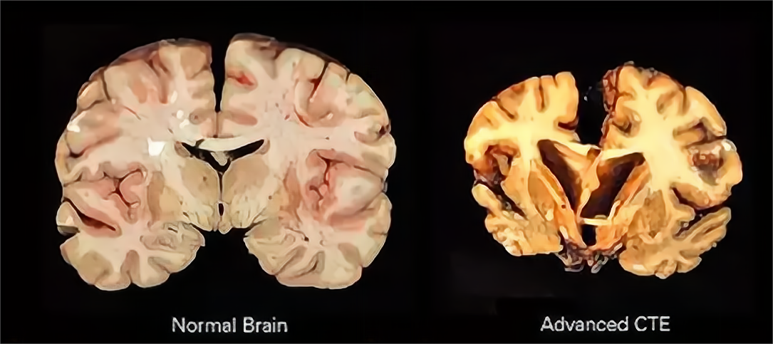 朊病毒到底有多强悍?