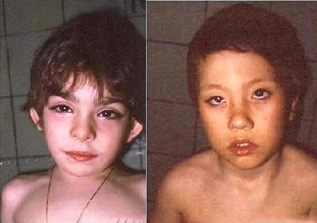 蓝妮妮是歌舞伎面谱综合征，歌舞伎综合症宝宝照片（大眼睛、尖下巴、精灵耳…长得太美也是一种病）