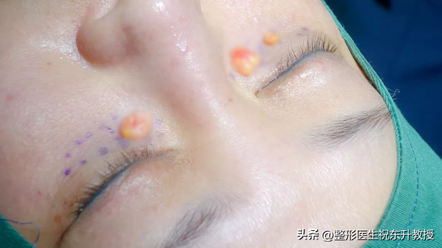 内切法去眼袋做完要多久时间，内切法去眼袋做完要多久时间可以化妆（作为做过眼袋手术的过来人）