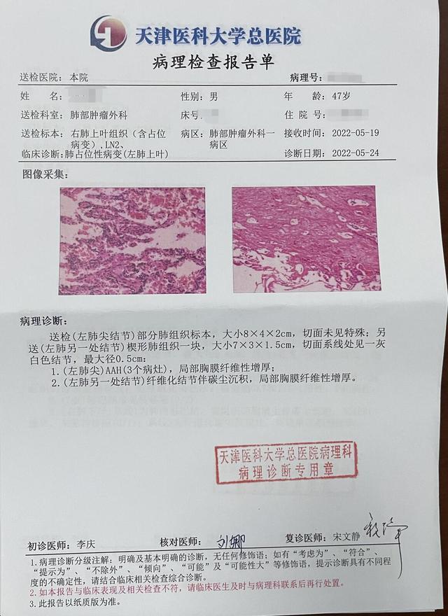 AAH，aah英语怎么读（<三九二三>肺磨玻璃结节切下来是AAH）