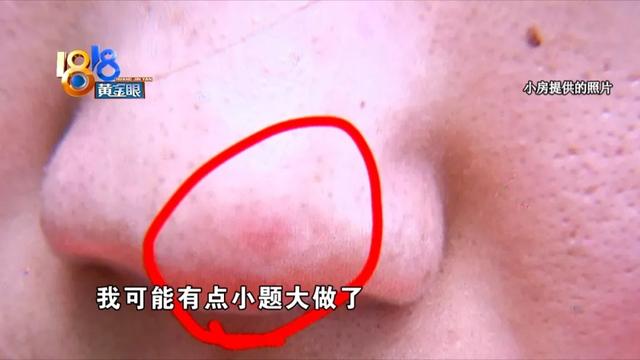 果酸换肤祛痘效果怎么样，果酸换肤祛痘效果怎么样的（“果酸焕肤”又红又肿）