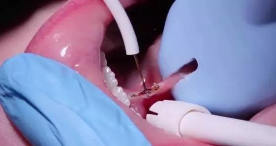 舌系带手术，舌系带手术最佳时间（孩子“大舌头”，必须挨这一刀）