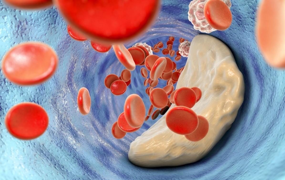 低密度脂蛋白水平降到多少是标准?