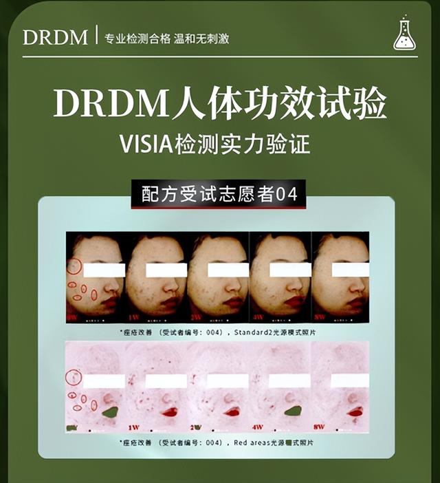 芦荟胶能祛痘吗，芦荟胶可以祛痘吗（复配制剂祛痘最强伴侣）
