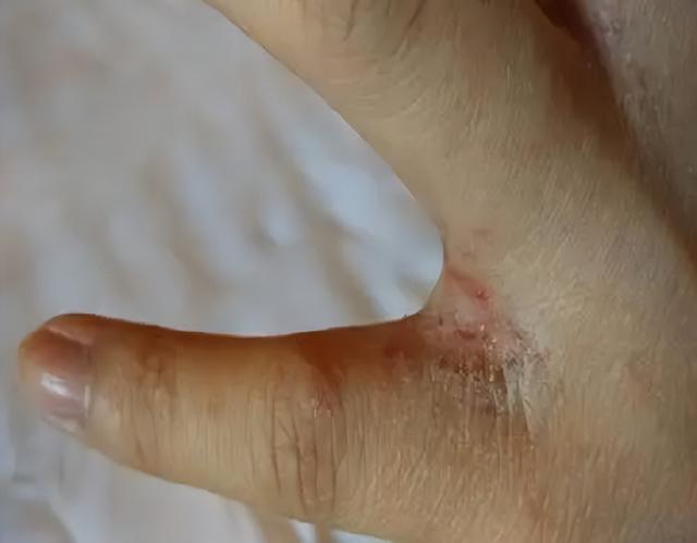 玫瑰糠疹吃什么药，玫瑰糠疹吃什么药好使（“万能皮肤药”炉甘石洗剂）