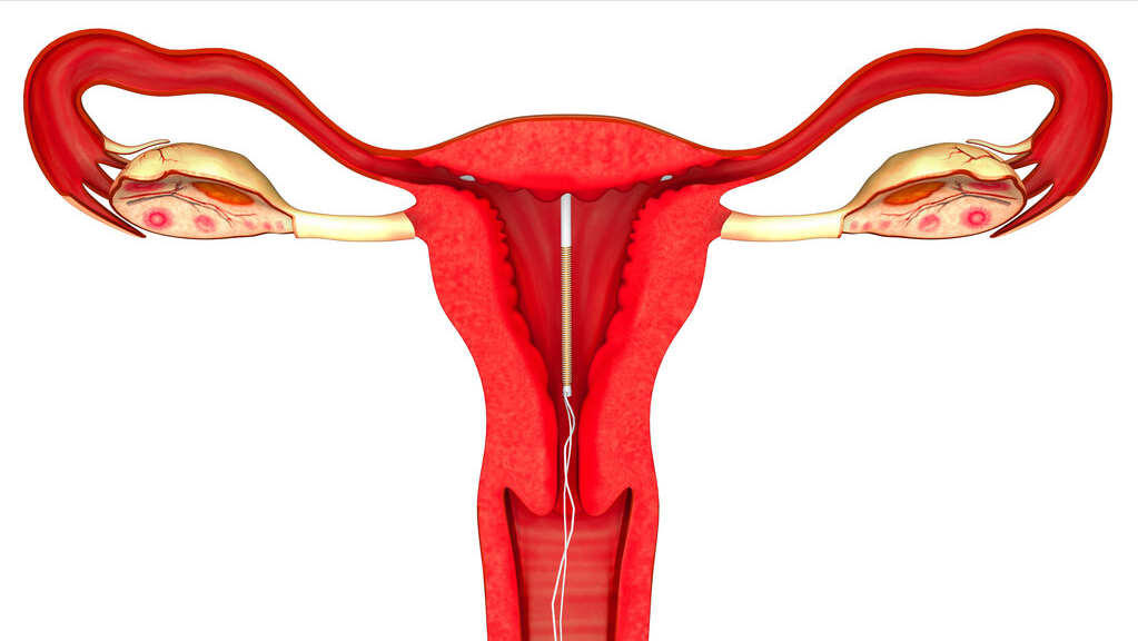 很多人可能不太了解节育环这种东西,它其实是放置于女性子宫内的一种