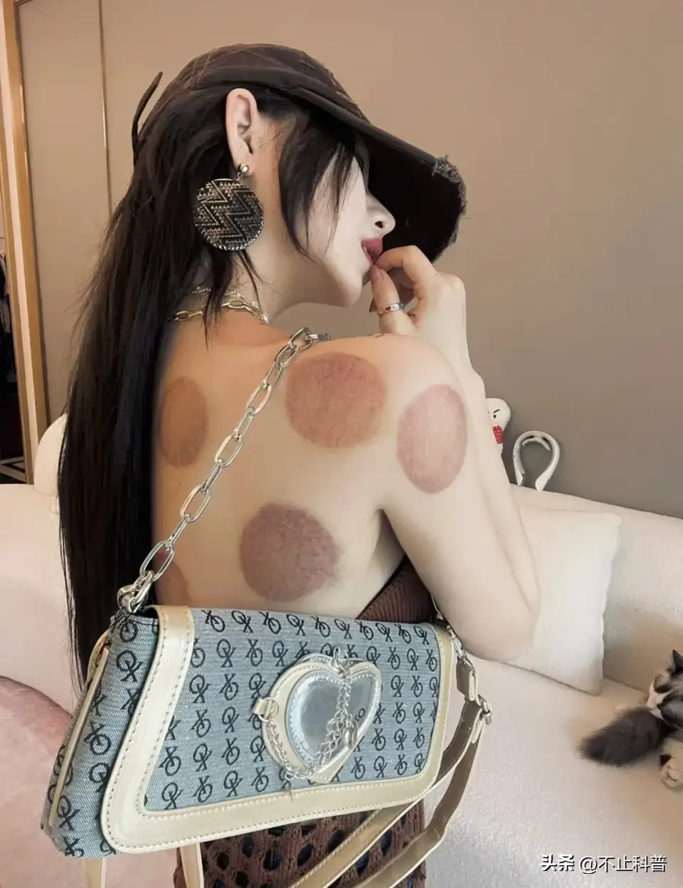 拔罐有哪些禁忌？