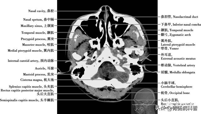 智力扣全套解法图解，智力扣九连环解法（详细标注版——颅脑CT正常解剖图谱）