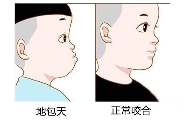 地包天矫正费用大概多少，地包天矫正的费用是多少（牙齿地包天，矫正要多久）