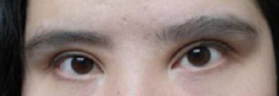 欧式大平行双眼皮，欧式大双和普通双眼皮（双眼皮容易做失败的3类人）