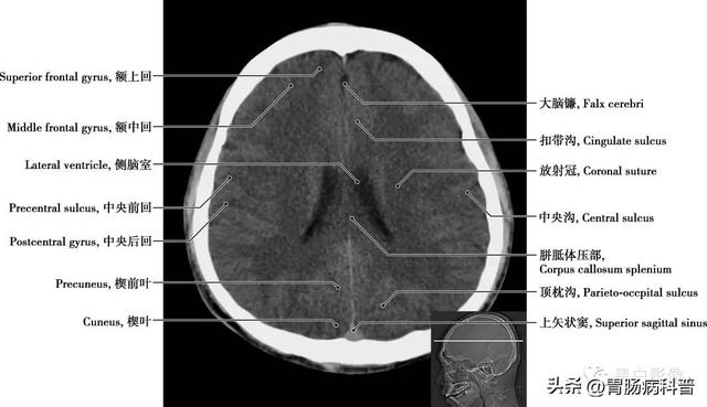 智力扣全套解法图解，智力扣九连环解法（详细标注版——颅脑CT正常解剖图谱）