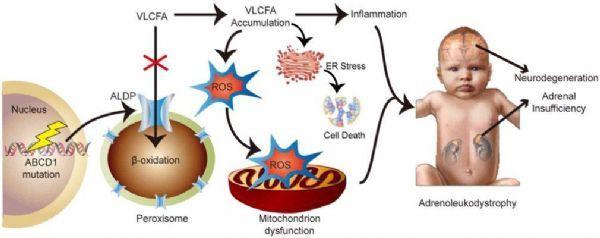 ald是什么病，ald罕见病治愈成功（第一个治疗脑肾上腺脑白质营养不良的基因疗法）