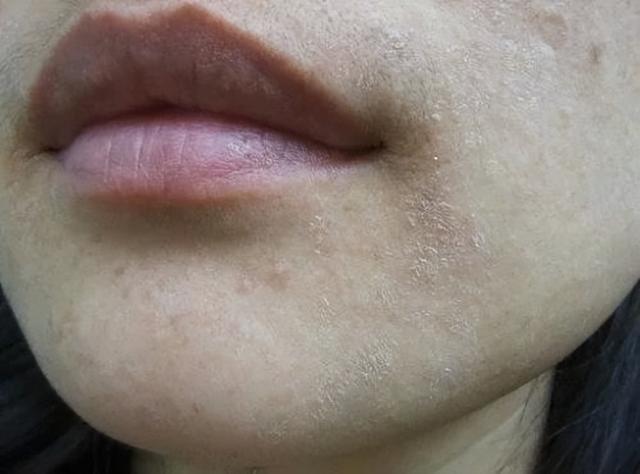 脸部能天天热敷吗，热敷脸有哪些功效与作用（面膜可以天天敷吗）