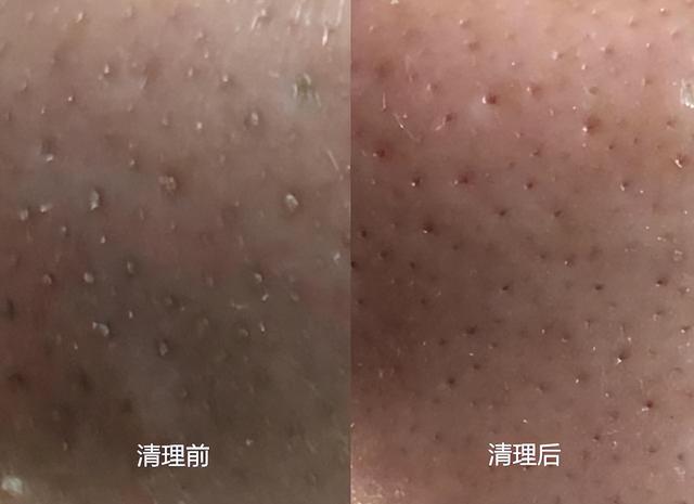 小气泡标准操作流程，美容机构的小气泡去黑头效果好吗