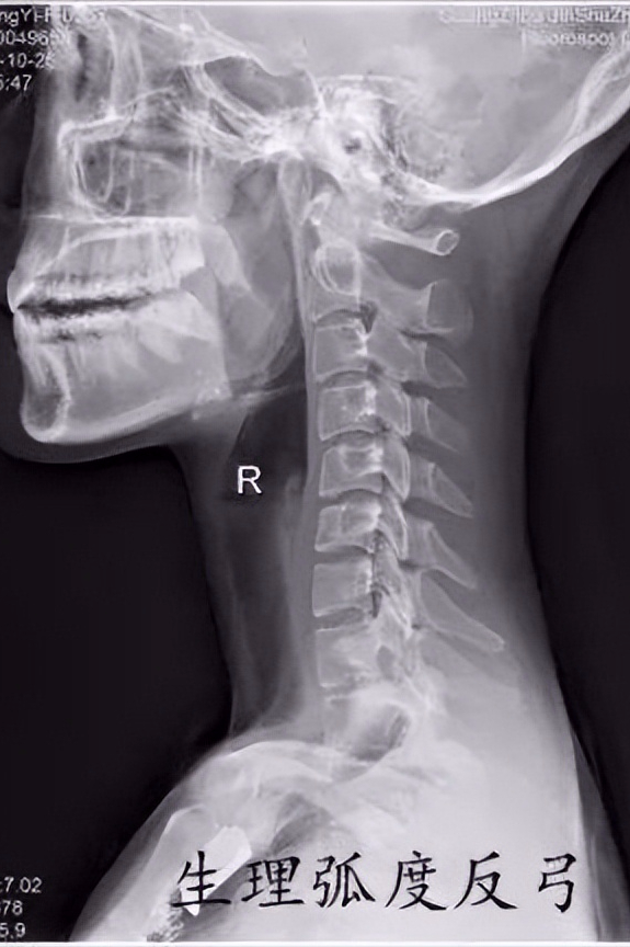 颈椎侧弯怎么矫正，颈椎病生理弯曲消失了怎么办