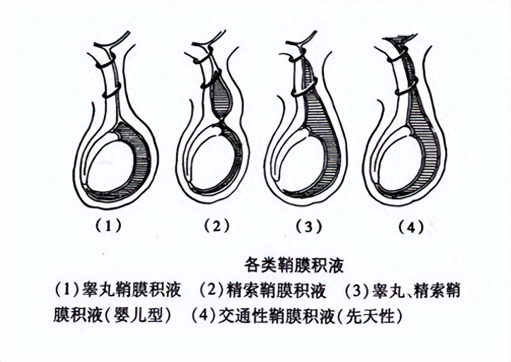二,两个蛋蛋明显不一样大的几种原因