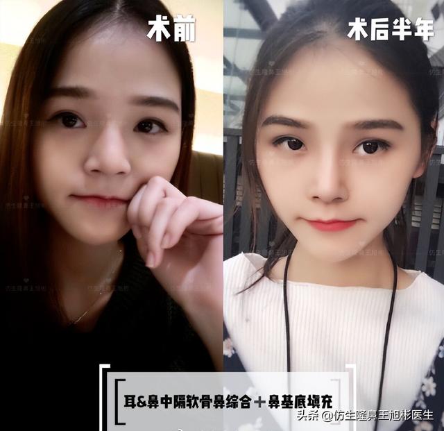 鼻基底填充能改善什么，鼻基底填充好处（鼻基底填充能改善法令纹吗）