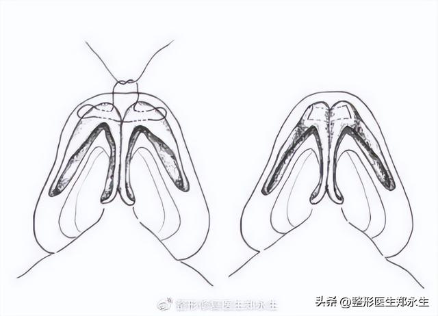 鼻头缩小术千万别做，鼻缩小手术千万别做（肉鼻子做了鼻头缩小结果越“缩”越“大”）