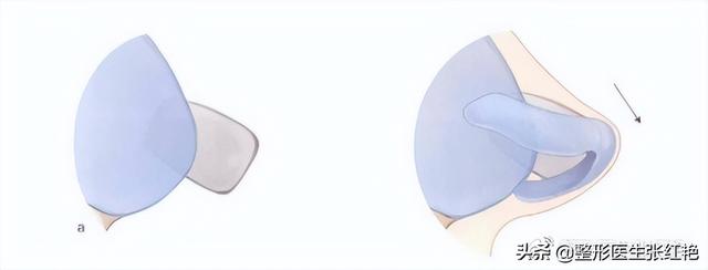 鼻孔大怎么办，鼻子太大怎么自然缩小（成功改造后气质“大变样”）