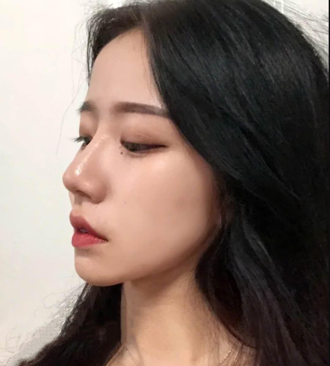 佰华利骨美容术隆鼻多少钱，隆鼻手术一般多少钱（隆鼻多少钱，假体隆鼻多少钱）