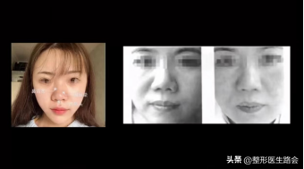 鼻翼肥大怎么办，鼻翼肥大怎么改善（如何改善鼻头圆和鼻翼宽）