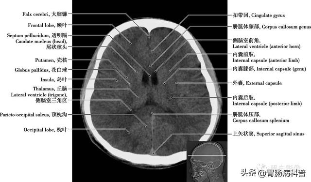 智力扣全套解法图解，智力扣九连环解法（详细标注版——颅脑CT正常解剖图谱）