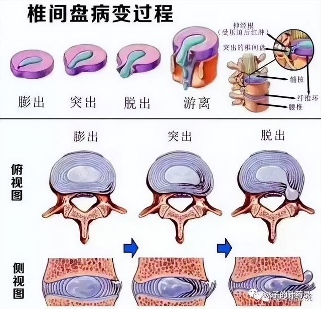 拔火罐图片分析图解图片