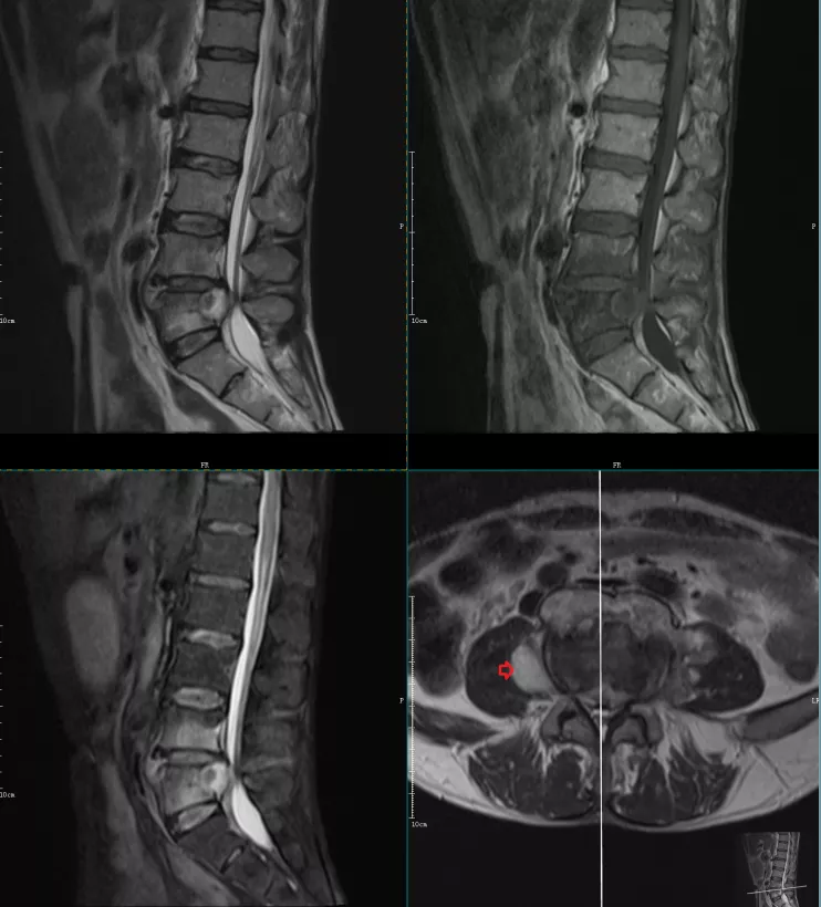 腰椎终板炎是什么病,发生机制,分型以及