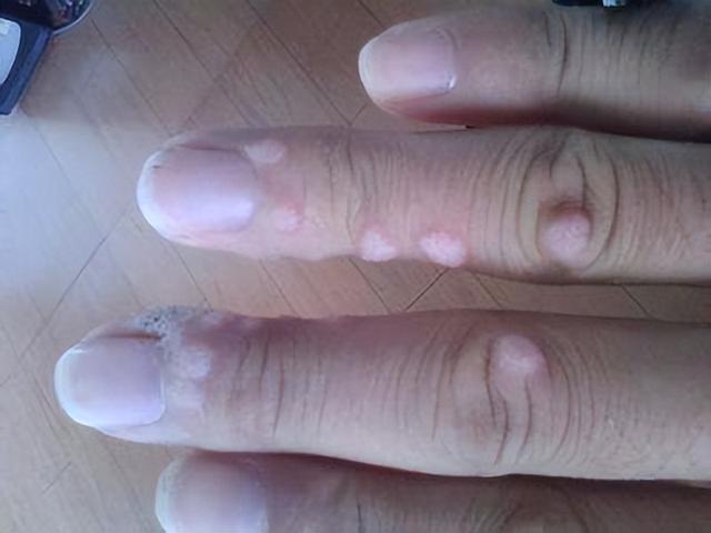 手上长一粒粒凸起图片白色，手臂上有米粒白色凸起图片（扁平疣和寻常疣、丝状疣的区别）