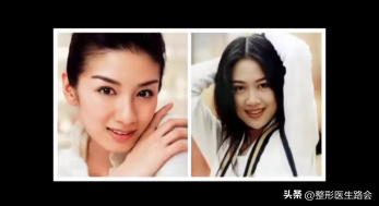 鼻翼肥大怎么办，鼻翼肥大怎么改善（如何改善鼻头圆和鼻翼宽）
