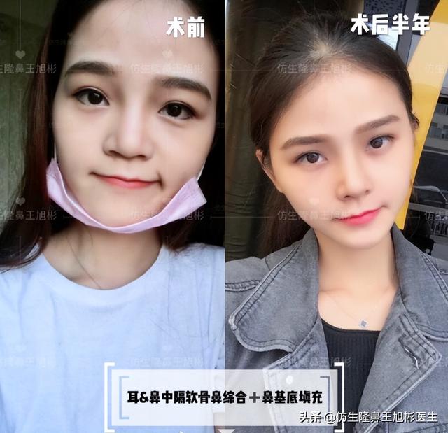 鼻基底填充能改善什么，鼻基底填充好处（鼻基底填充能改善法令纹吗）