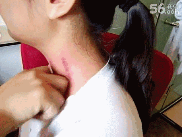 揪痧,奥密克戎的一个克星,希望感染者受益!