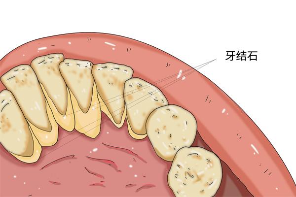 牙结石需要清理吗，牙结石是要洗牙清除吗（自己能不能抠掉牙结石）