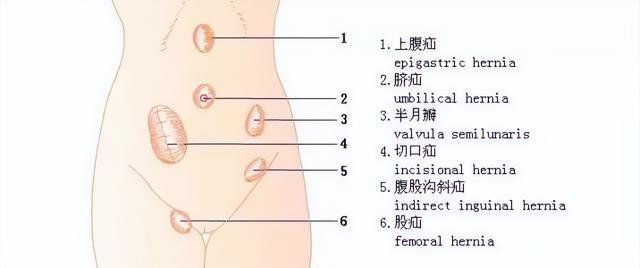 疝气手术微创好还是普通手术好，疝气手术好还是微创好（一日腹腔镜疝手术为您解决担忧）