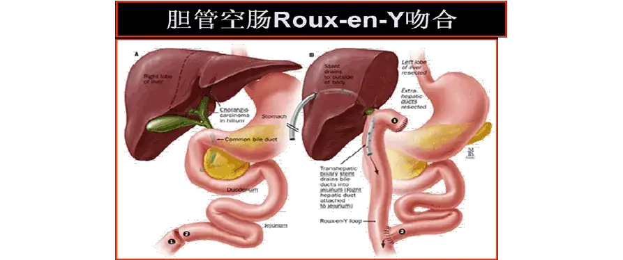胆管癌胆肠吻合术后，病人的存活时间大概是多久？