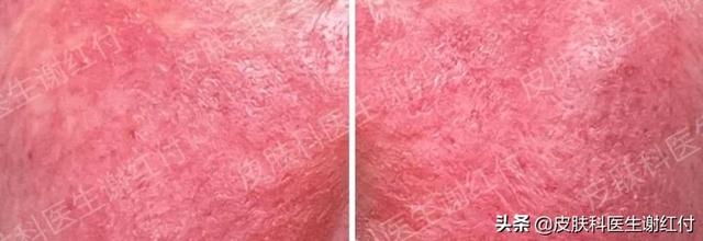 什么是激素脸图片，如何判断是不是激素脸（停药就反复，到底应该怎么办）