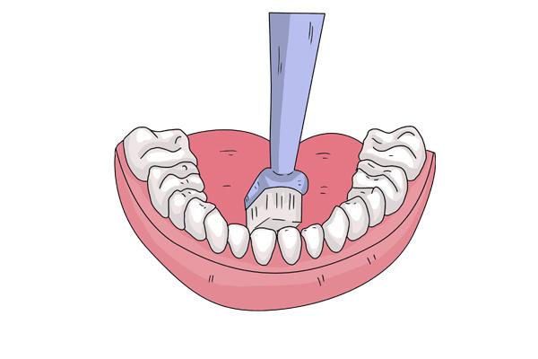 牙结石需要清理吗，牙结石是要洗牙清除吗（自己能不能抠掉牙结石）