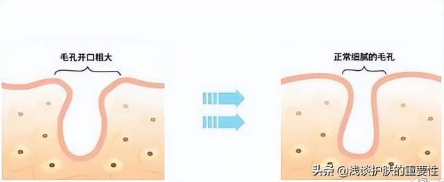 外油内干毛孔粗大护肤品推荐，改善毛孔粗大的护肤品（哪些护肤品可以改善毛孔粗大、t区出油的情况）