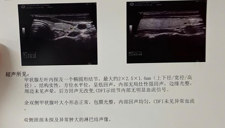 促甲状腺激素偏低(促甲状腺激素3.83孕妇严重吗)