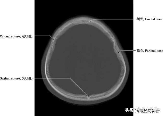 智力扣全套解法图解，智力扣九连环解法（详细标注版——颅脑CT正常解剖图谱）