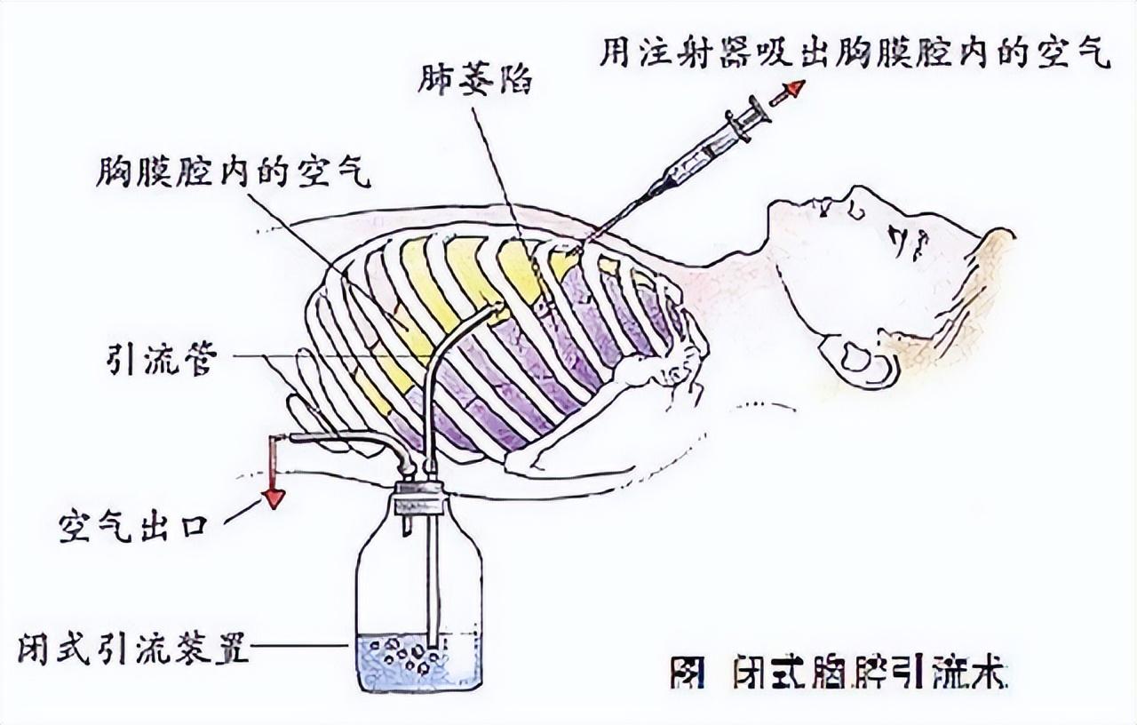 诺尔曼（白求恩临终前）