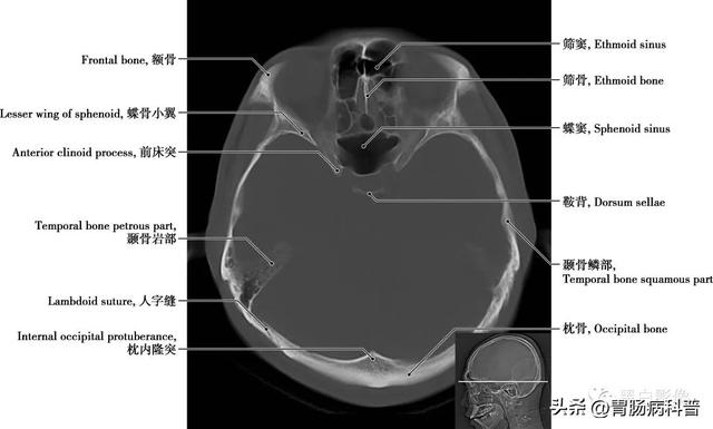 智力扣全套解法图解，智力扣九连环解法（详细标注版——颅脑CT正常解剖图谱）